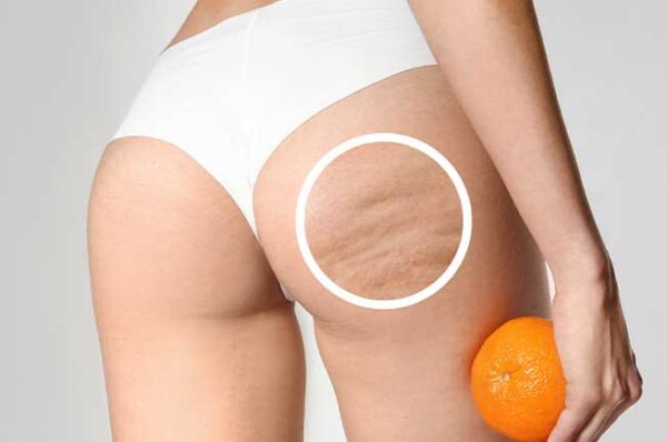 Mujer con celulitis o piel de naranja