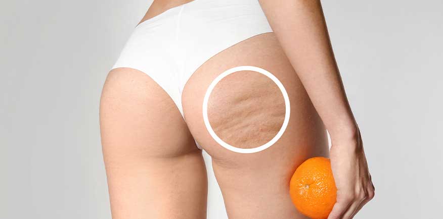 Mujer con celulitis o piel de naranja
